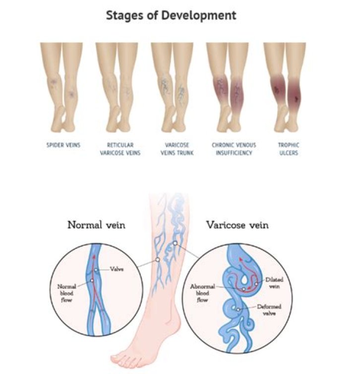 What does a leg with venous insufficiency look like?